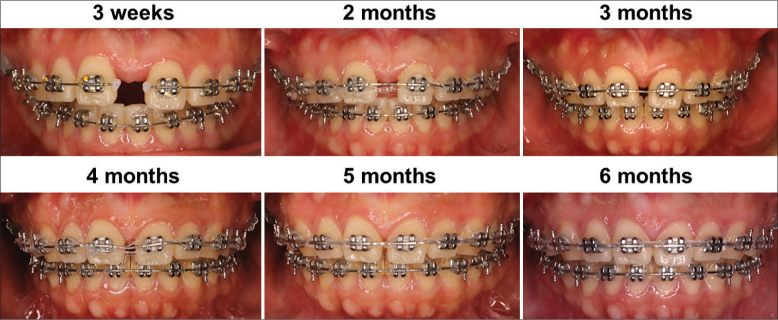 Niti bending (V bend on 16 22 Niti between 11 21 and elastic thread for closing diastema), Niti: Nickel-titanium.