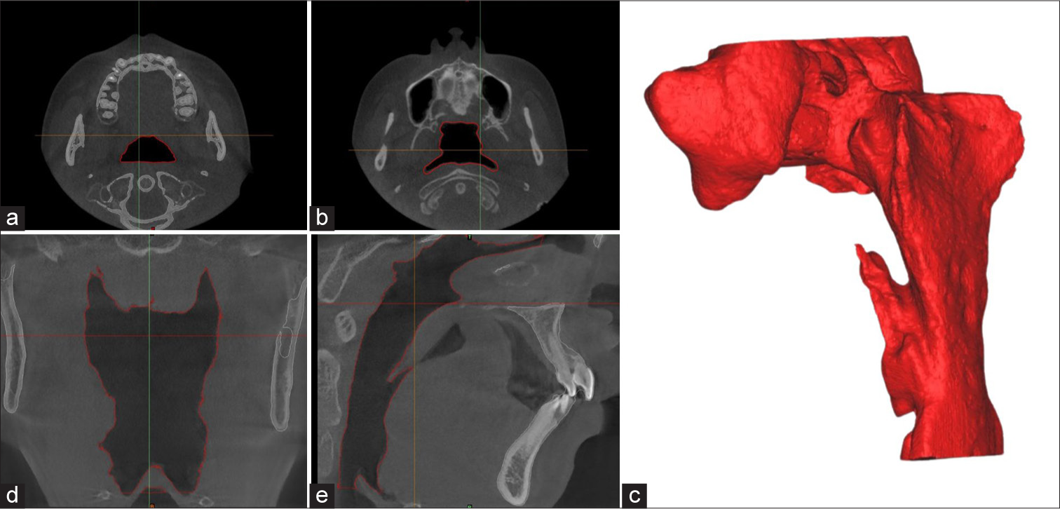 (a) Axial slice of the middle part of the upper airway. (b) Axial slice of the superior part of the upper airway. (c) Total upper airway volume after segmentation. (d) Corona slice of the upper airway. (e) Sagittal slice of the upper airway.