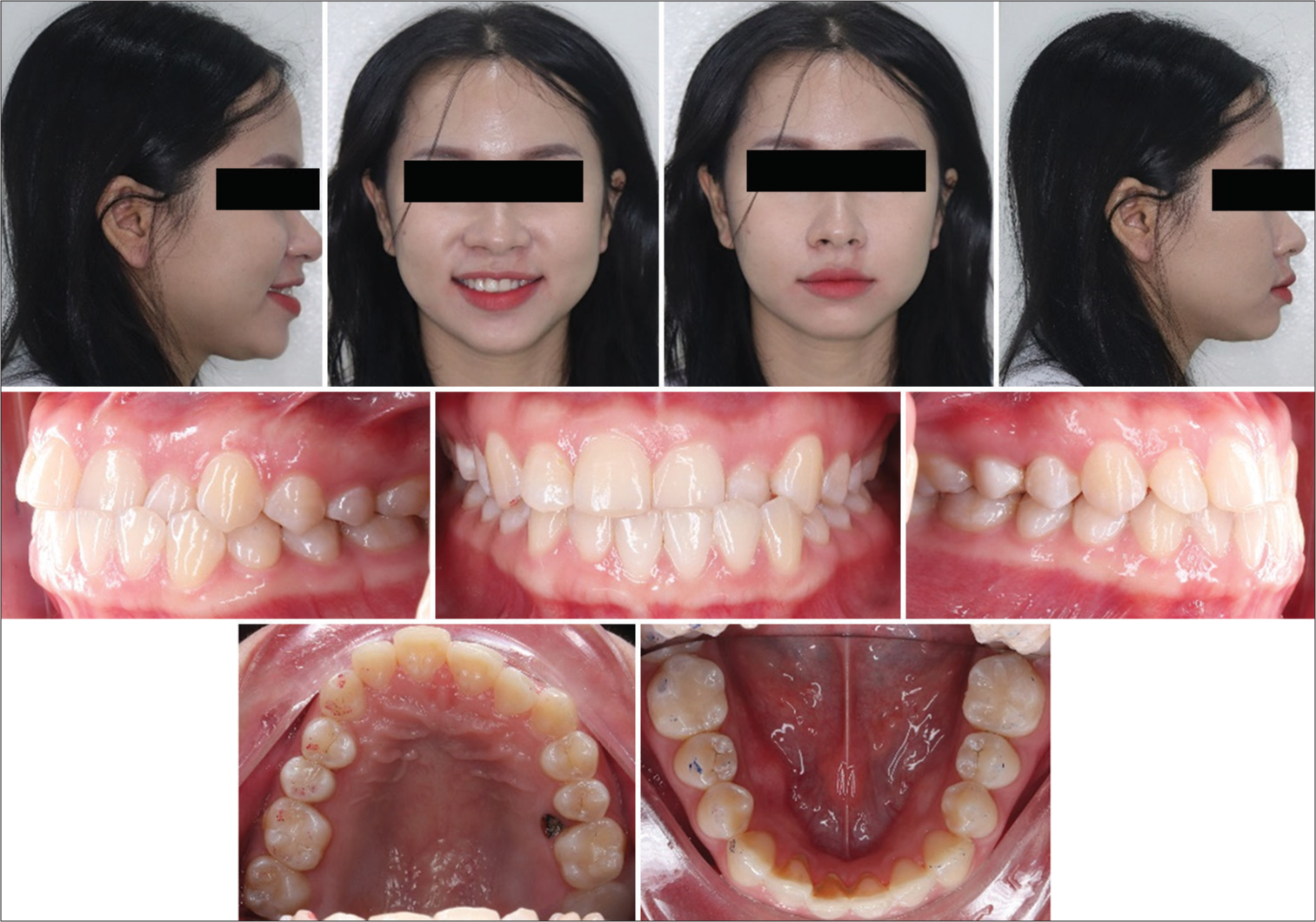 Pre-treatment intra and extraoral pictures.