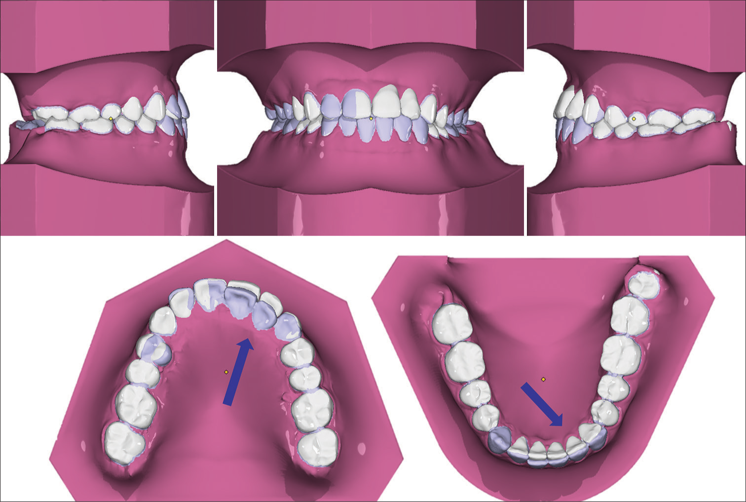 3D simulation of the treatment for checking mechanics before treatment. Blue arrow shows the simulated movement and position of the teeth before and after treatment.