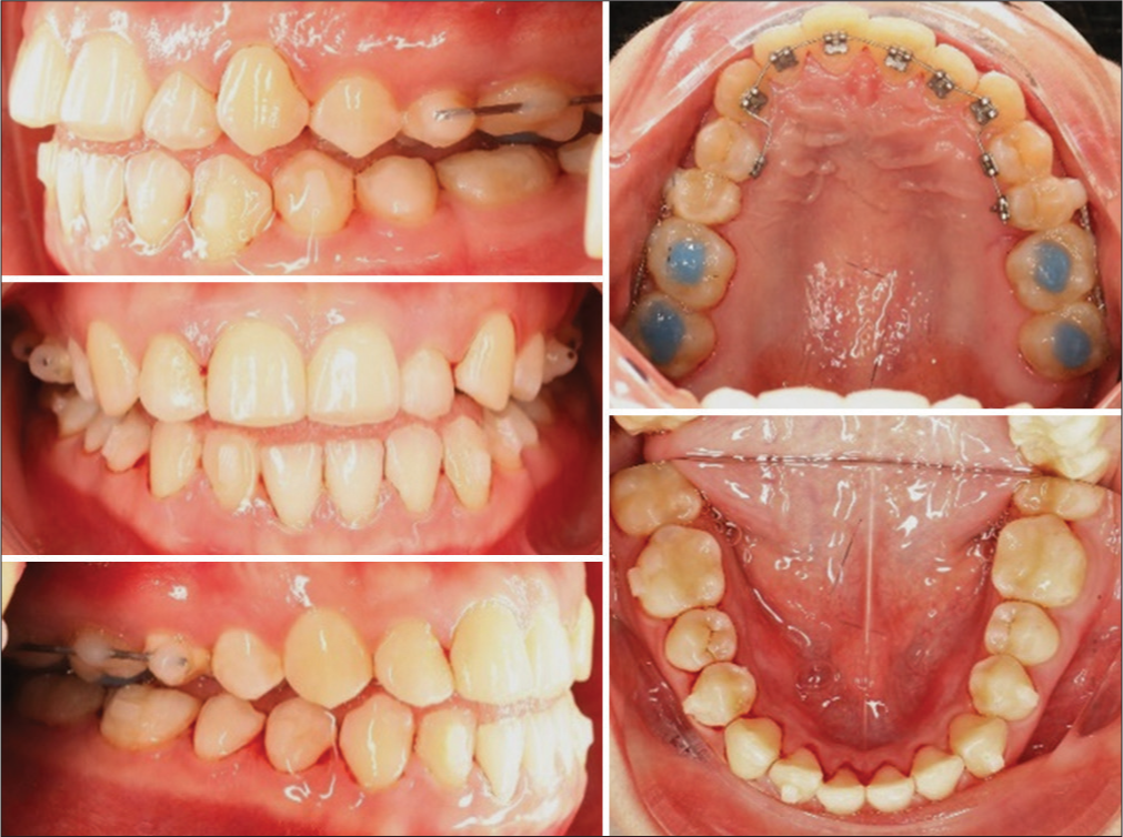 2D braces, attachments bonding, and interproximal reduction at 1st day of treatment.