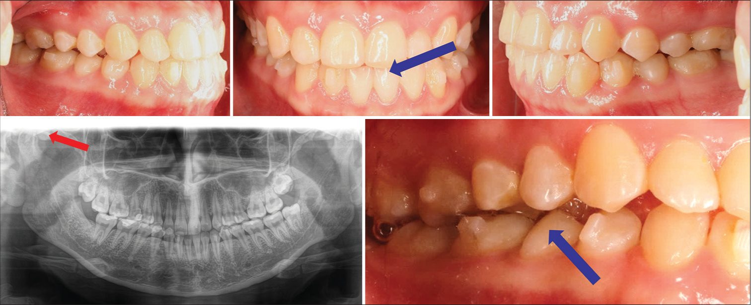 After 2 months, the mandible shifted to the left, as the panoramic shows, because the patient got TMD during the treatment. The patient had a scissor bite on the right side. Blue arrows shows the mandible shifted to the left during the treatment. Red arrow shows the abnormal position of the condylar.