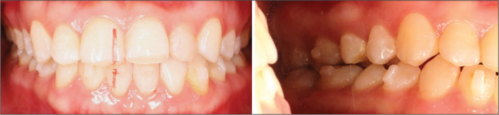 After 5 months of treatment, we continued with in-house aligners and performed fillings on 22 teeth to prevent mandible movement to the left. Afterward, the occlusion came back to normal.