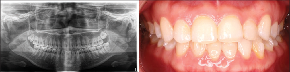 After 7 months, everything was going well but there was a resorption of the right condyle.