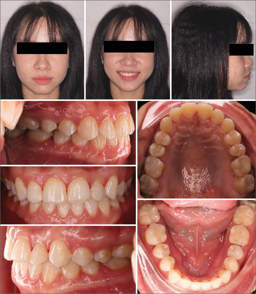 Post-treatment intra and extraoral pictures after 8 months.