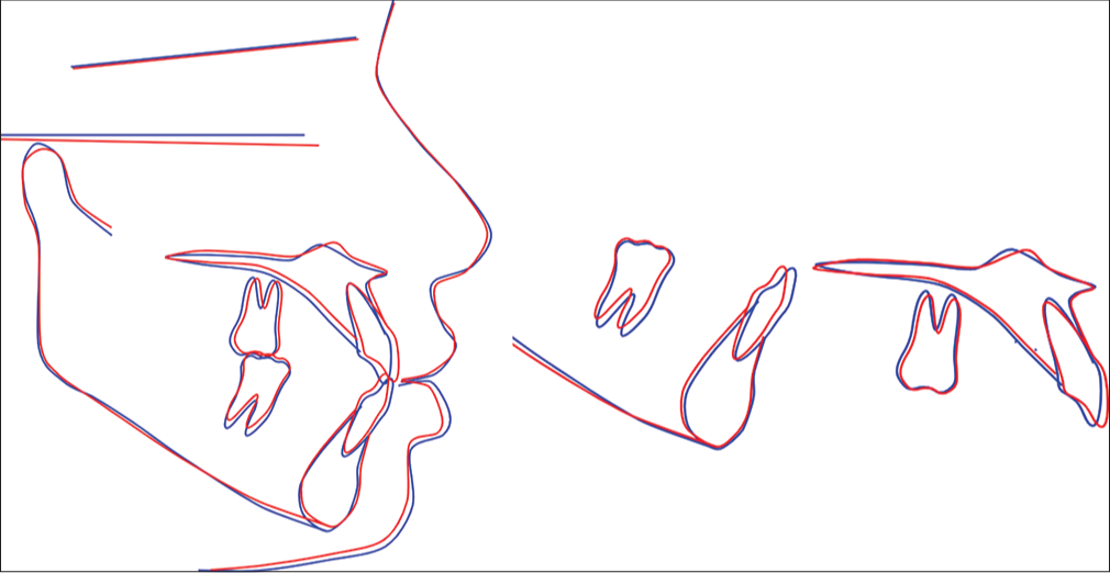 Superimposition before and after treatment. Blue lines: Before treatment; Red lines: After treatment.