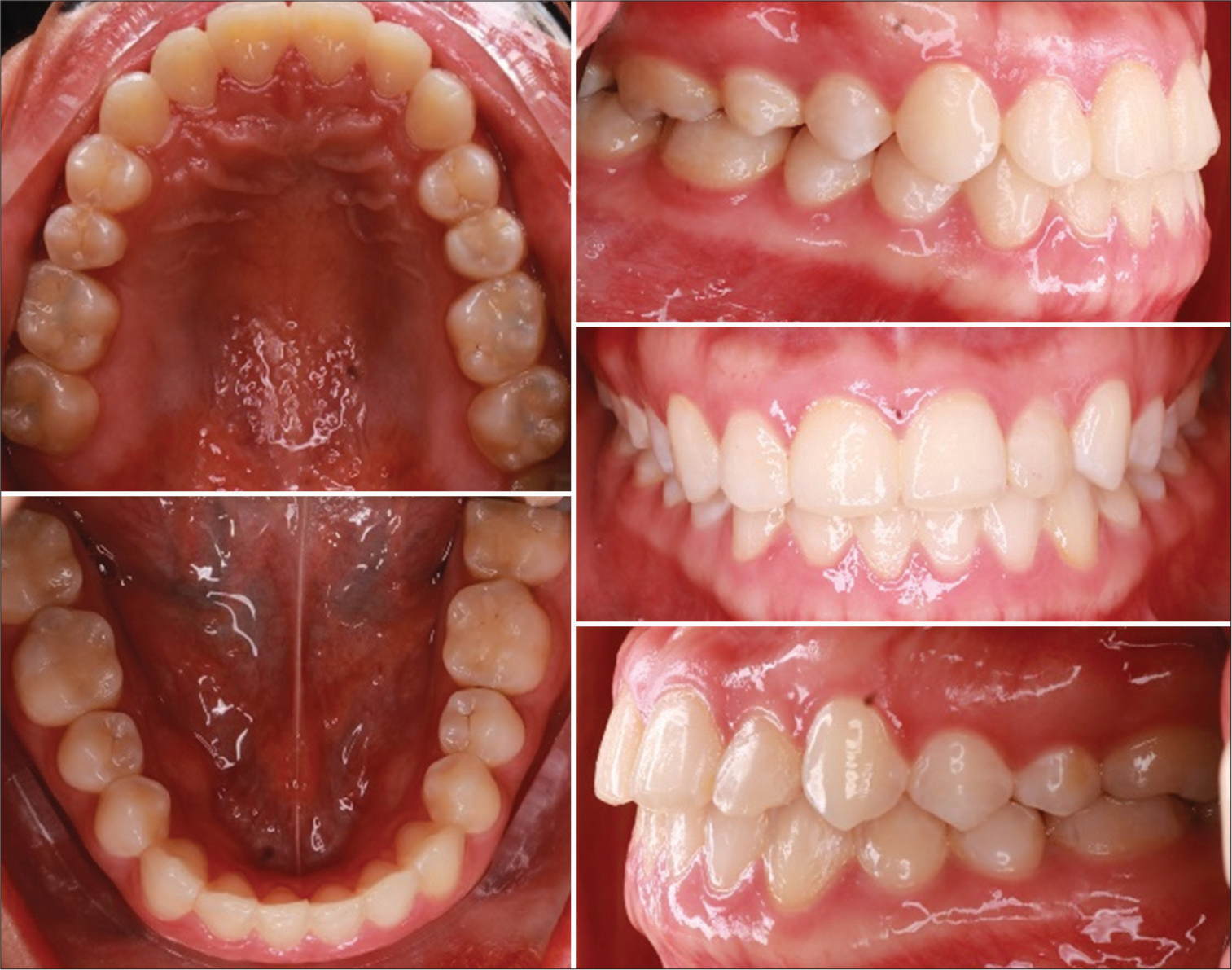 1-year follow-up treatment – The occlusion is stable.