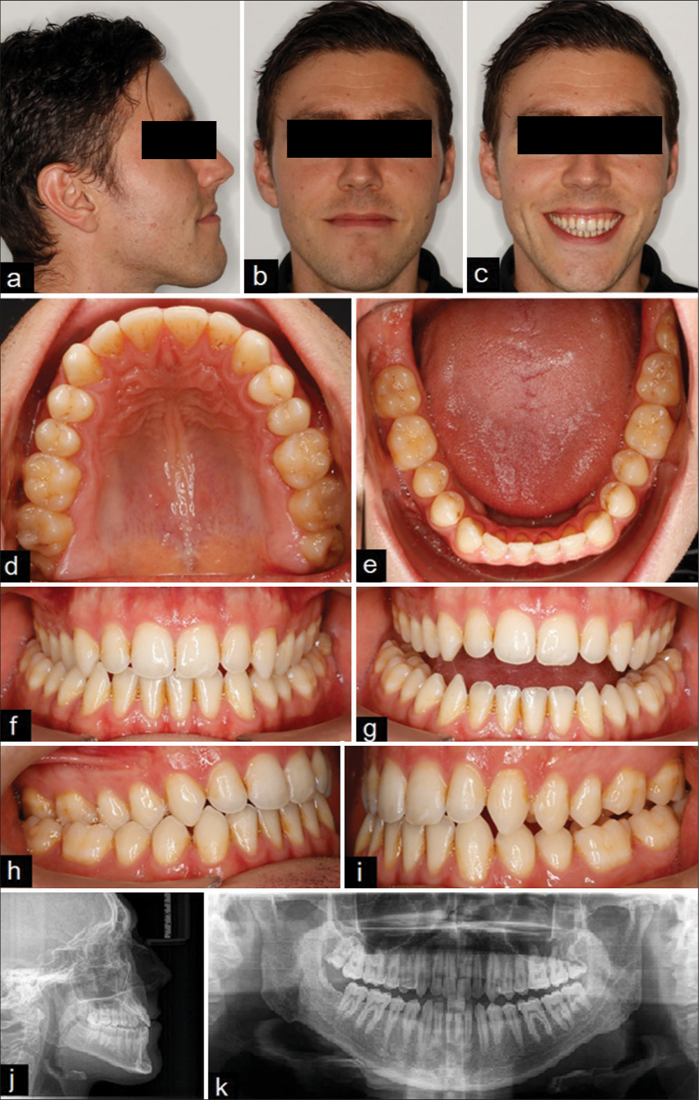 (a-i) Pre-treatment extraoral and intraoral photos. (j-k) Pre-treatment panoramic radiograph and lateral cephalometric