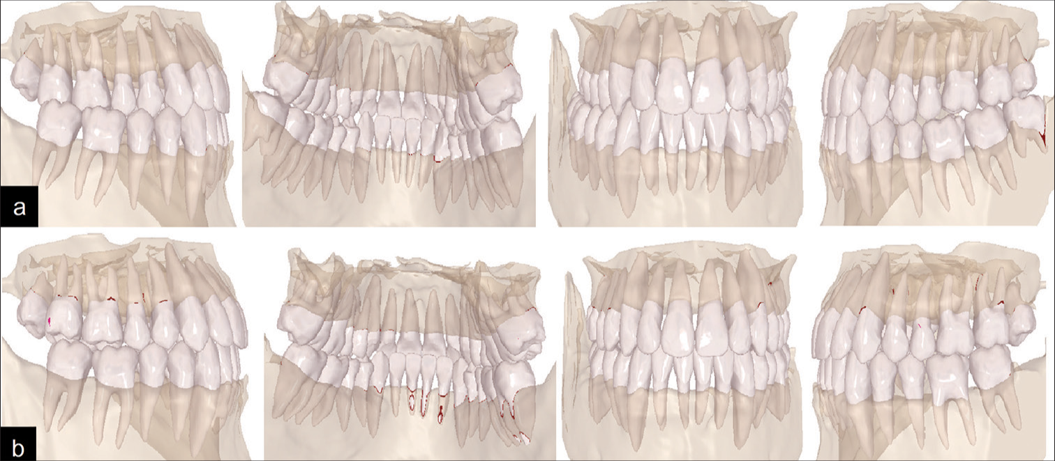 (a) Pre-expansion assessment using CBCT integrated with ClinCheck. (b) Post-expansion assessment using CBCT integrated with ClinCheck.