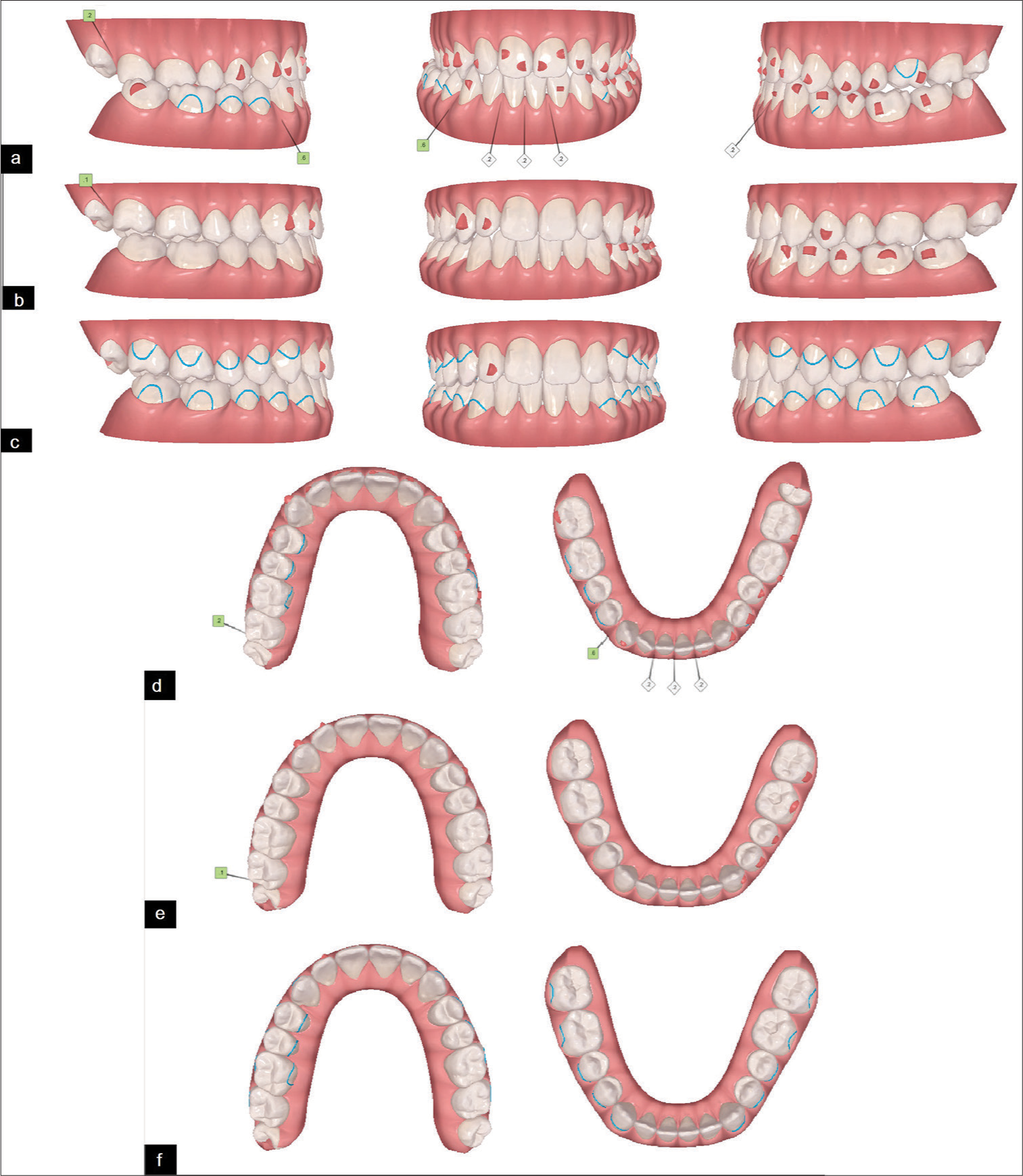 (a-c) Virtual setup on the ClinCheck™ software (occlusion views): a: at the beginning of the first phase (including 42 aligners; 0.2 mm interproximal enamel stripping between the lower incisors), b: At the beginning of the second phase (including 22 aligners), c: at the end of the treatment. (df) Virtual setup on the ClinCheck™ software (occlusal views): d: at the beginning of the first phase (including 42 aligners; 0.2 mm interproximal enamel stripping between the lower incisors), e: At the beginning of the second phase (including 22 aligners), f: at the end of the treatment.