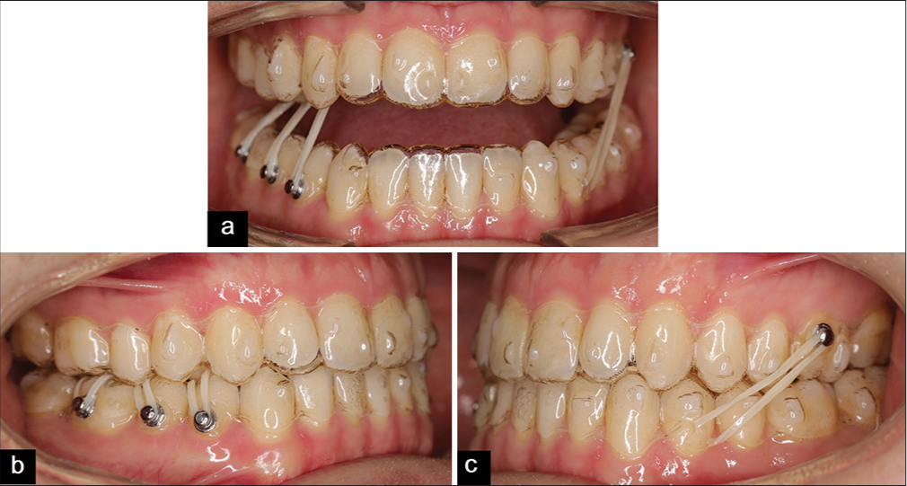 (a-c) Mid-treatment intraoral photos showing intermaxillary elastics.