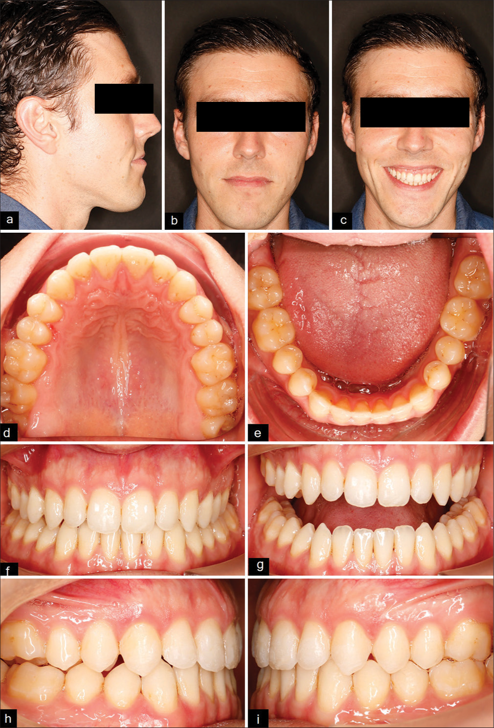 (a-i) Extraoral and intraoral photos at the end of the first phase.