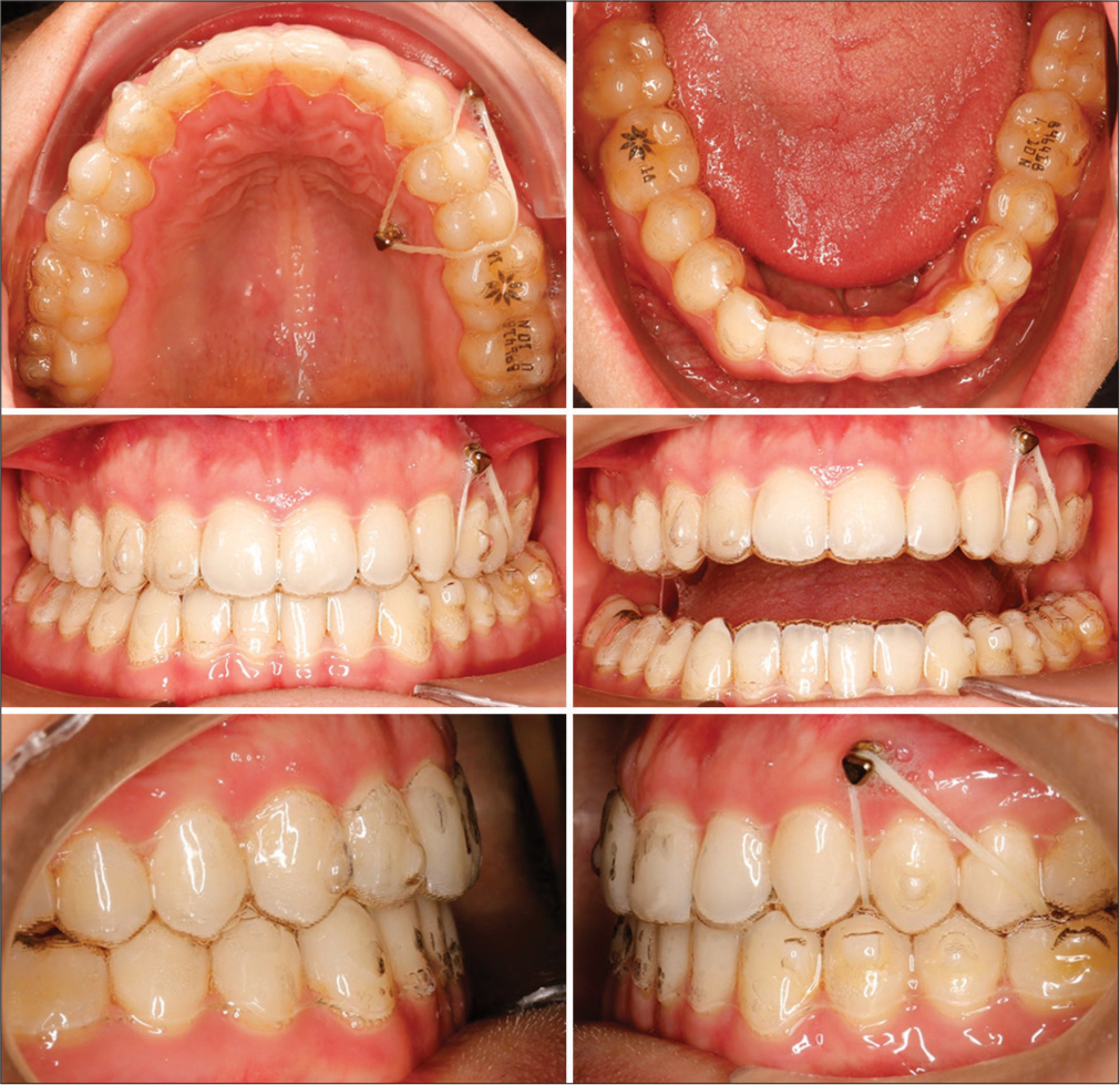 Mid-treatment intraoral photographs at the second phase showing canting correction.