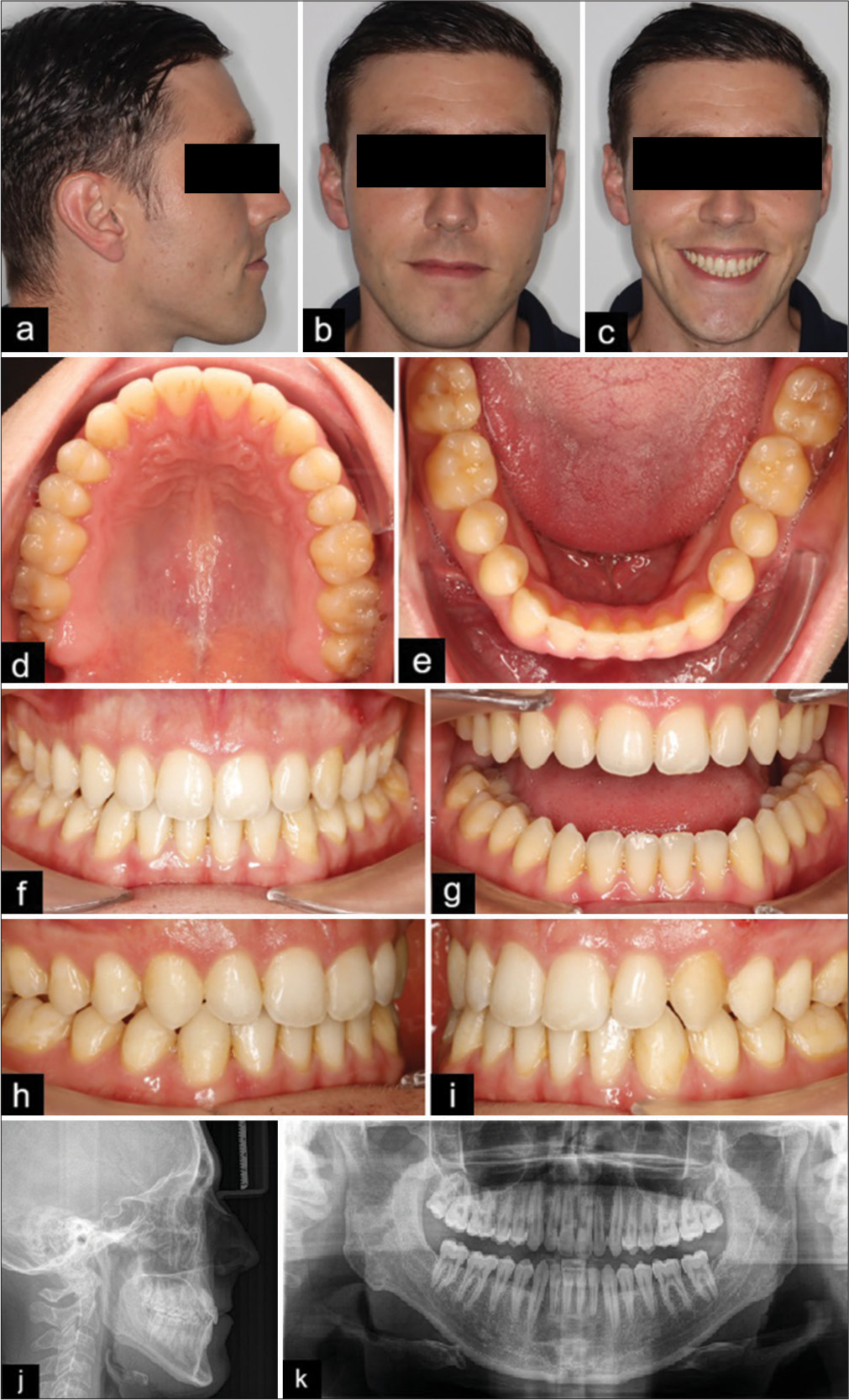 (a-i) End of treatment records: Extraoral and intraoral photos. (j-k) End of treatment records: Panoramic radiograph and lateral cephalometric radiograph.