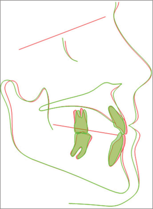 Superimposition of pre and post lateral cephalometric radiographs. Red pre-treatment and Green post treatment.