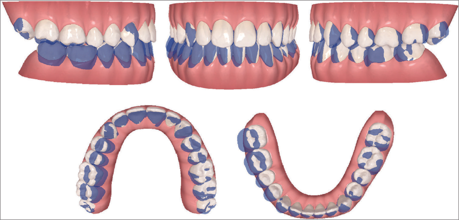 Superimposition of the digital models at the first phase by the ClinCheck™ software.