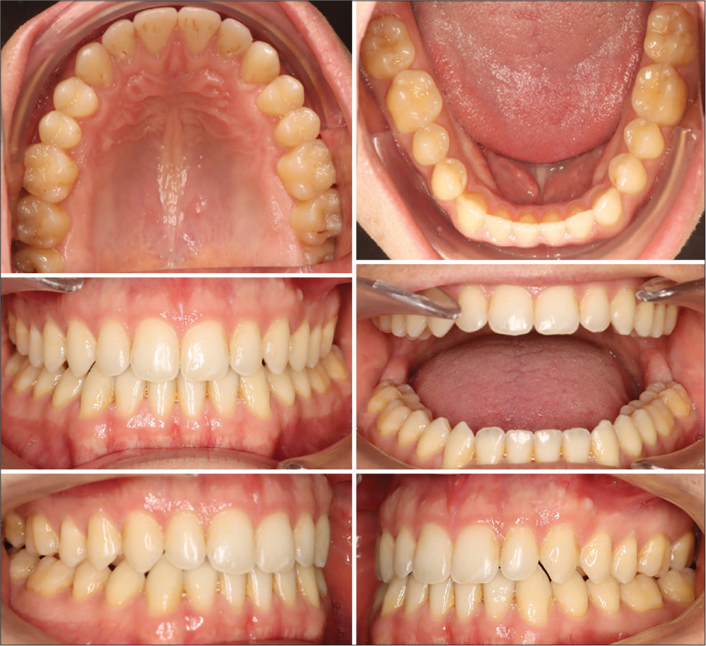 Intraoral photographs of the follow-up and retention period.