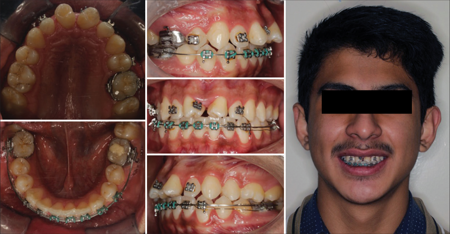Extraoral and intraoral photographs after COVID-19 global lockdown.