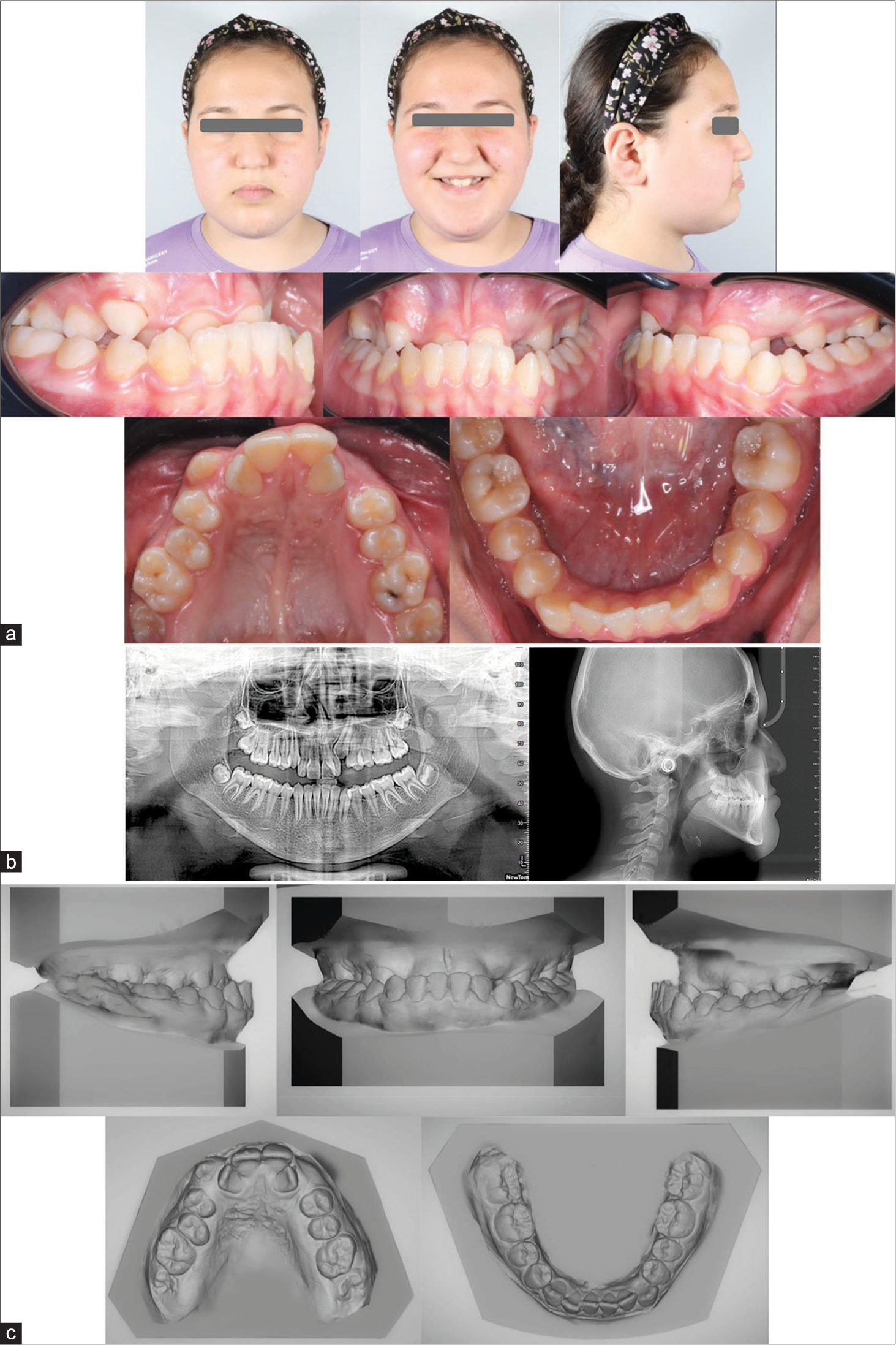 Shows (a) Pre-treatment extra and intra-oral photograph; (b) Pre-treatment radiography (O.P.G) and Cephalometric analysis (T1); (c) Pre-treatment models.