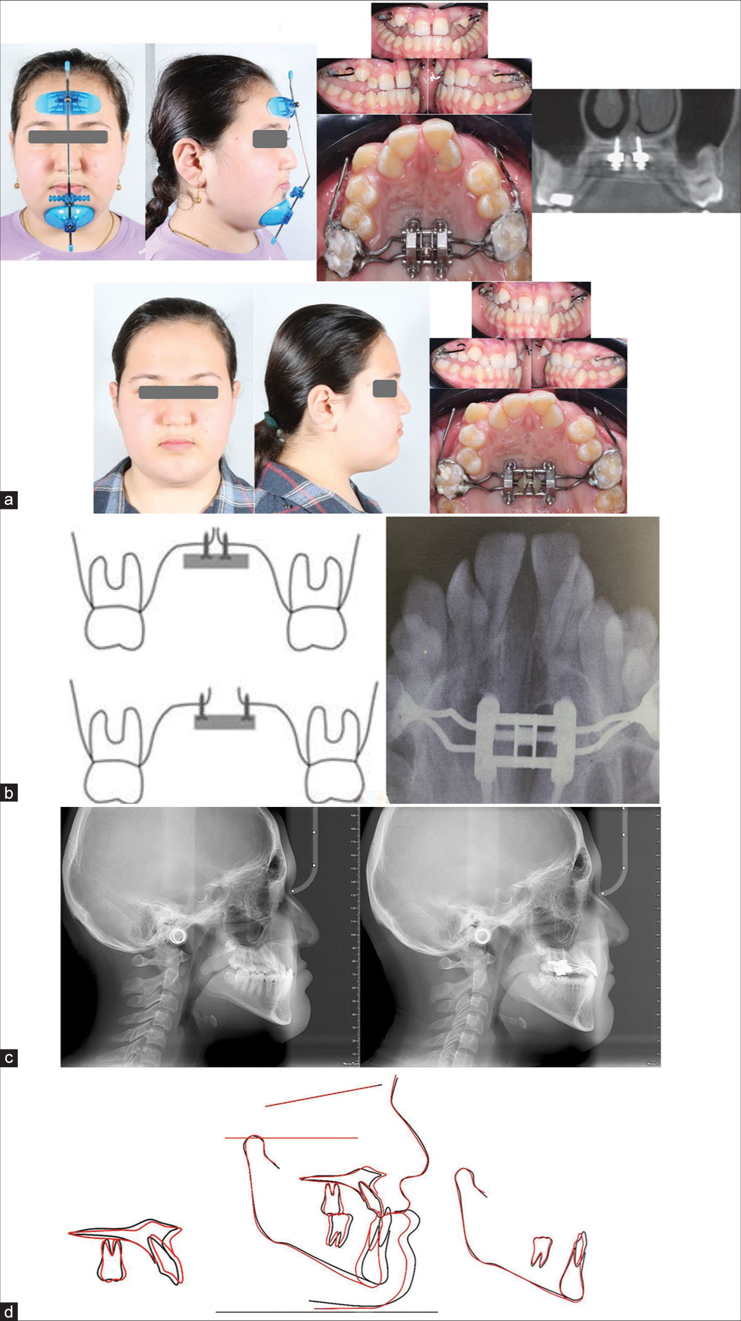 Shows (a) intraoral and extraoral changes after using a facemask with (MARPE) appliance; (b) radiographical transverse changes (Occlusal radiography) after maxillary expansion; (c) cephalometric radiographic anteroposterior skeletal and incisor inclination changes after facemask therapy; (d) superimposition after facemask therapy [Black line: before treatment; Red line: after treatment].