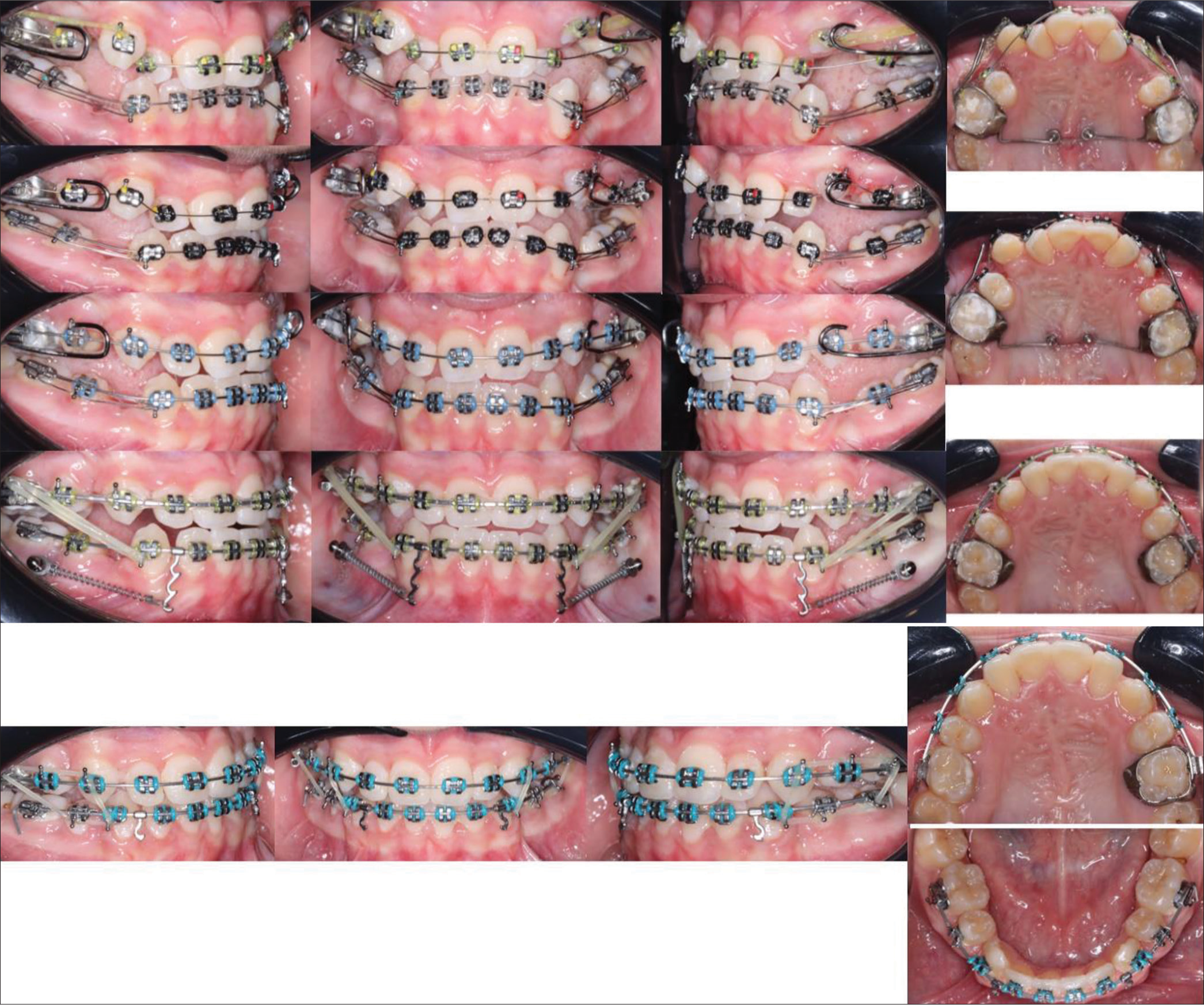 Mid treatment (mechanics) intra oral pictures with fixed appliances.