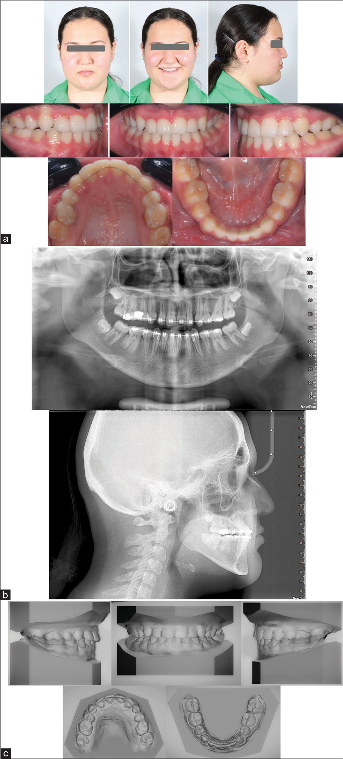 Show (a) Post-treatment extra and intra-oral photography; (b) Post-treatment radiograph (O.P.G. and cephalogram), pre-treatment (T1) and post-treatment (T2) cephalometric measurements; (c) Post-treatment models.