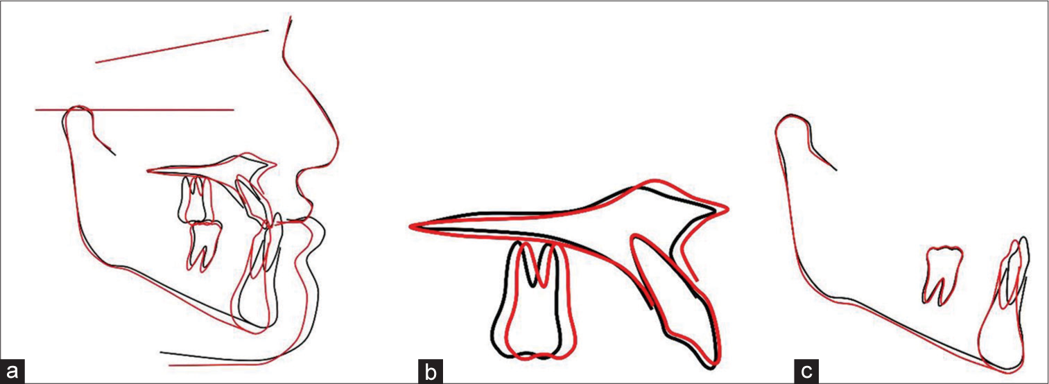 Cephalometric superimposition [black line: before treatment; Red line: after tretment]: (a) General superimposition over Sella-Nasion plane; (b) Maxillary superimposition; (c) Mandibular superimposition.