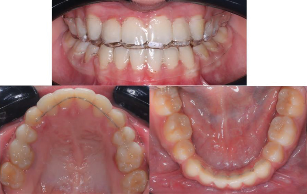 Retention protocol used double fused vacuum formed retainer with upper and lower fixed lingual retainers.