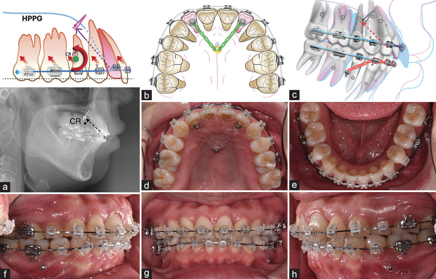 (a) The line of force lies in front of the center of resistance of upper dentition; therefore, total intrusion and counterclockwise rotation of the upper dentition could be achieved. (b and c) Mechanical design: Intrusive distalization of upper dentition by high-pull palatal gear technique. Intrusive distalization of lower dentition by bilateral apically-positioned mini-screws. (d-h) Intraoral photos at the 8th month of active treatment. CR (T): Center of resistance of the total dentition. Purple arrow: the line of force from lateral incisors to mid-palatal screw. Red arrows: the intrusive force applied on rigid stainless archwire, resulting the counterclockwise rotation of upper occlusal plane relative to the total center of resistance CR(T). Green eyelets: the force of elastic chain applied on lateral incisors. Yellow area: the protective resin on the palatal screw to reduce irritation. Red arrow: line of force application from the laterals to mid-palatal screw. Red eyelets: the intrusive force applied by the elastic chain attached on the apically-positioned mandibular miniscrews. HPPG: High-pull palatal gear.