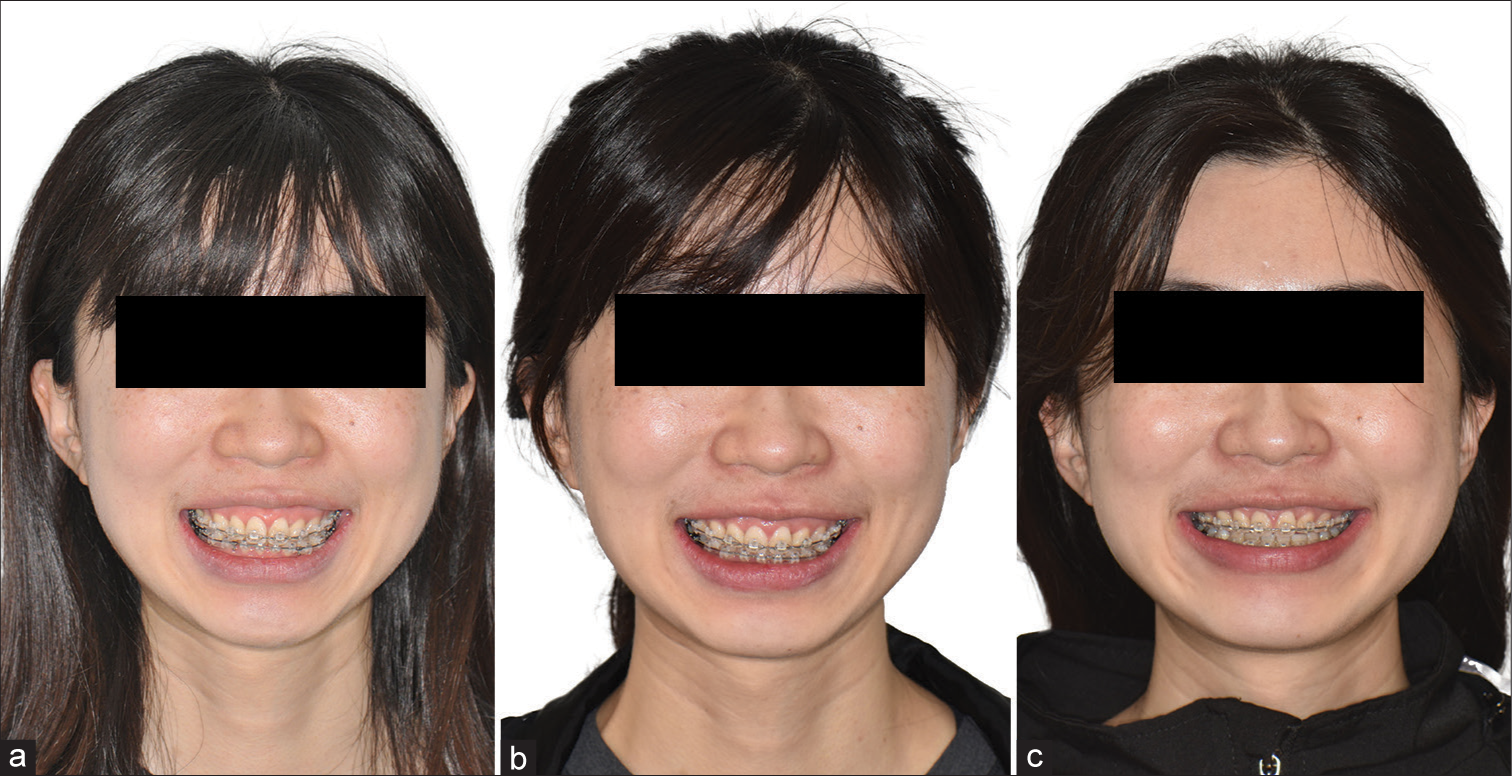 Gummy smile was gradually improved by high-pull palatal gear technique at the (a) 5th, (b)10th and (c)18th month of active treatment.