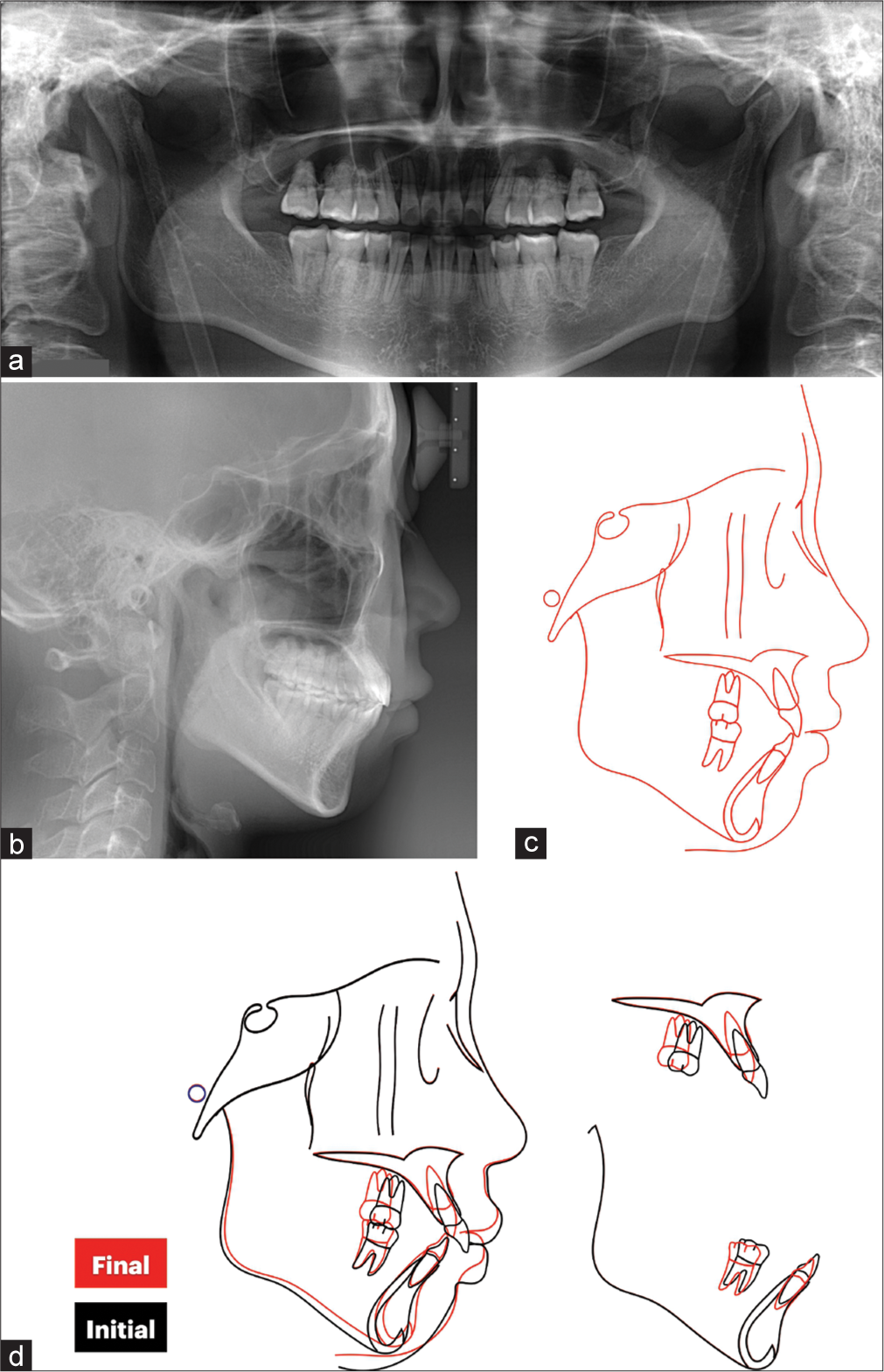 (a) Posttreatment panoramic radiograph, (b) posttreatment lateral cephalogram, (c) cephalometric tracing and (d) cephalometric superimposition showed the intrusive distalization of both arches.