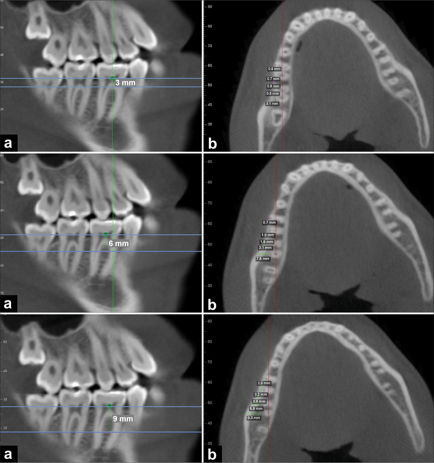 (a) Sagittal tomographic image with markings at 3 mm, 6 mm, and 9 mm apical from the cementoenamel junction (b) and axial slice at the respective markings.