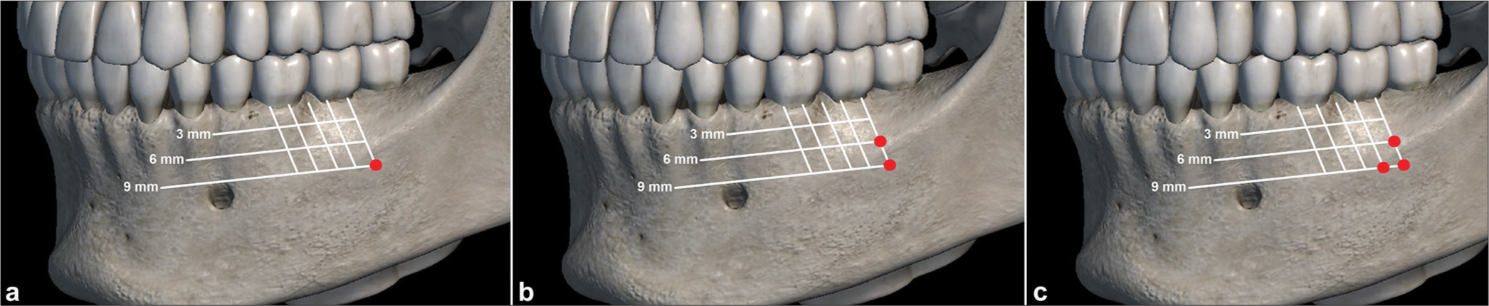 Safe sites for mandibular buccal shelf mini-screw insertion. (a) Hyperdivergent patients; (b) neutral patients; (c) and hypodivergent patients.