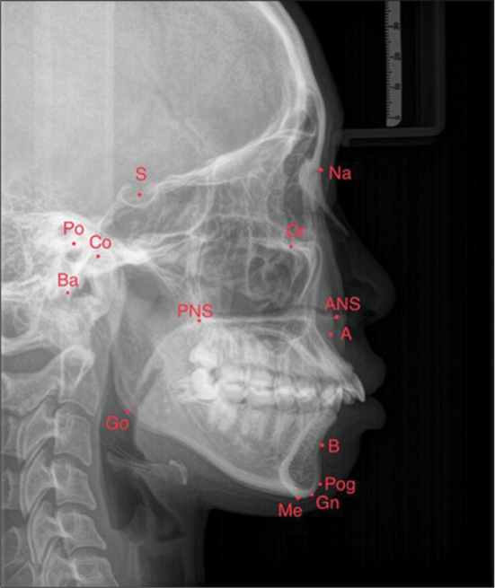 Simulation image of a point on the bone on cephalometric radiographies. S: Sella, N: Nasion, Po: Porion, Co: Condylion, Ba: Basion, Go: Gothion, PNS: PNS Point, Or: Orbital, ANS: ANS point, A: A point, B: B point, Pog: Pogonion, Gn: Gnathion, Me: Menton.