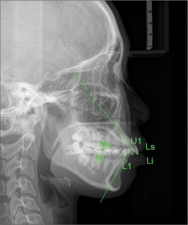 Simulated image of dental index points on cephalometric radiographies. U1: Upper central incisor, L1: Lower incisor, Ls: Labrale superius, Li: Labrale Inferius, Ms: Molar superior, Mi: Molar Inferius.