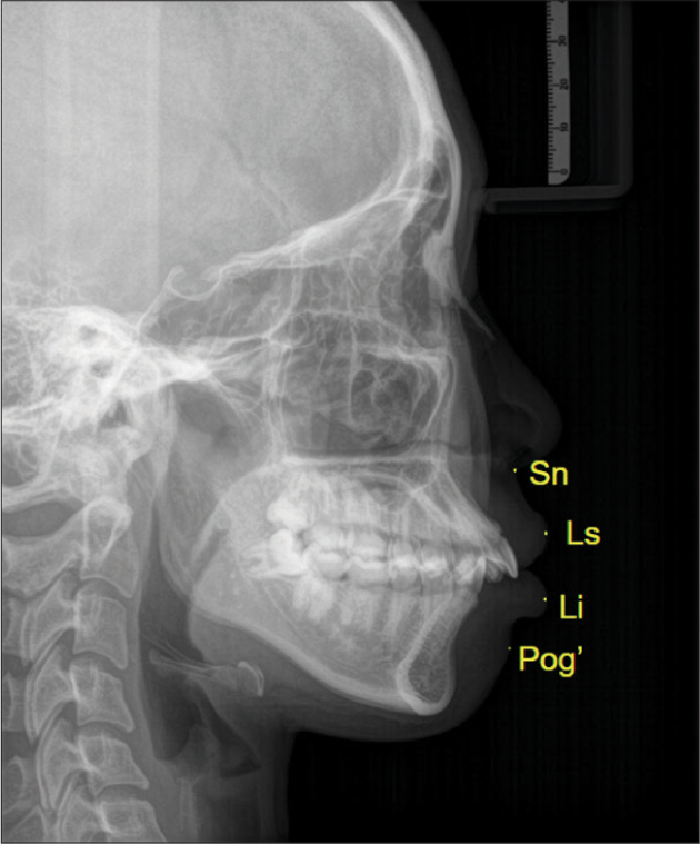 Simulation image of soft-tissue profile on cephalometric radiographies. Sn: Subnasale, Ls: Labrale superius, Li: Labrale inferius, Pog’: Pogonion’