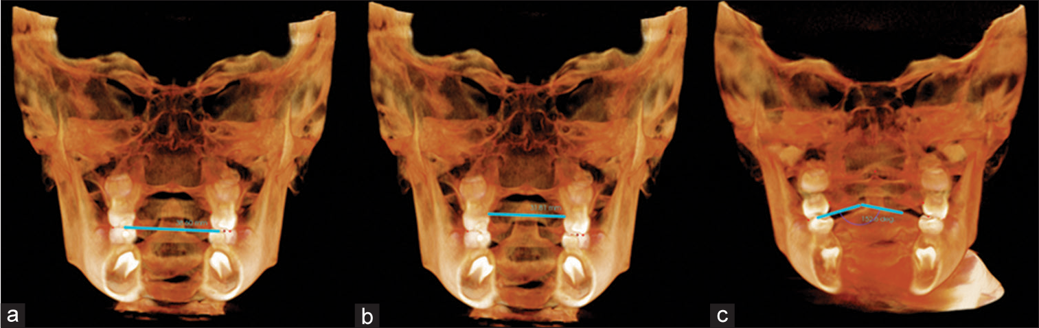 (a-c) Molar intercuspal width, molar cementoenamel junction width, and molar angle.