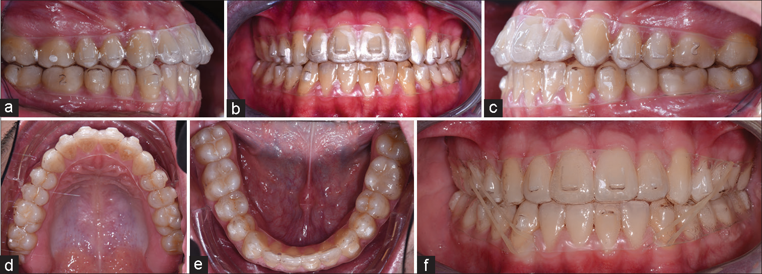 Treatment progress with clear aligners. (a) intra-oral right lateral view with clear aligners, (b) intra-oral frontal view with clear aligners, (c) intra-oral left lateral view with clear aligners, (d) upper occlusal view with clear aligners, (e) lower occlusal view with clear aligners, (f) intra-oral frontal view with clear aligners and class III elastics.