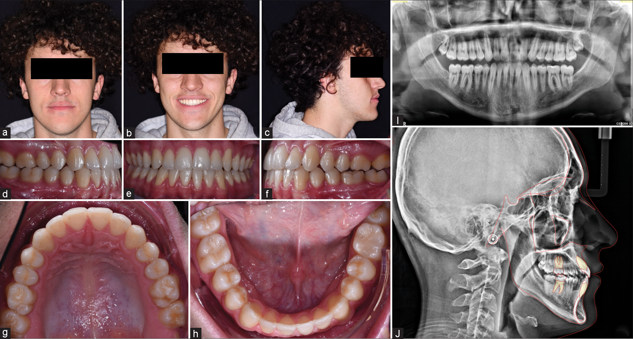 Final extraoral (a-c), intraoral photos (d-h), panoramic X-ray (i), lateral cephalogram (j).