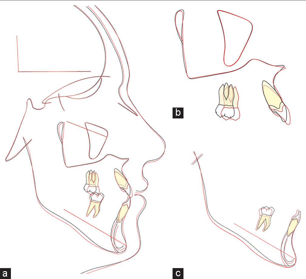 (a) superimposition on cranial base, (b) on maxillary stable structures, (c) on mandibular stable structures.
