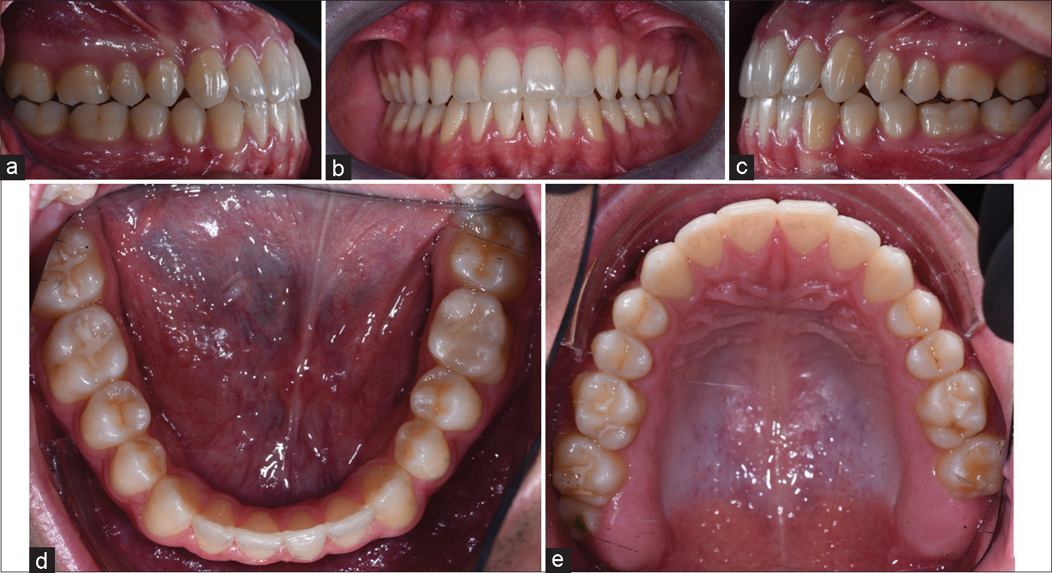One-year follow-up intraoral pictures. (a) intra-oral right lateral view, (b) intra-oral frontal, (c) intra-oral left lateral view, (d) upper occlusal view, (e) lower occlusal view.