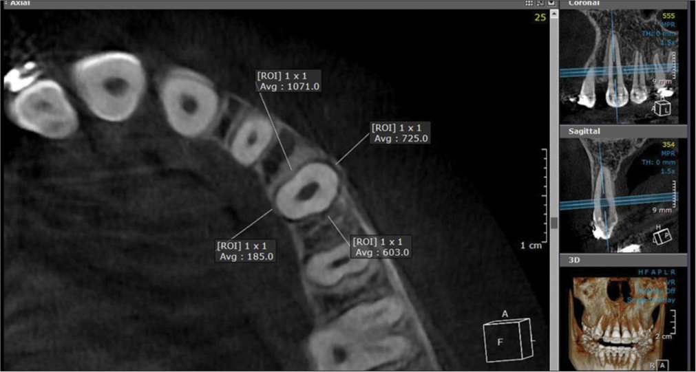 Evaluation of alveolar bone density from cone-beam computed tomography area sections, 2 mm from the alveolar crest. Grey scale density values were measured at four regions around the maxillary canine: mesial, distal, buccal, and palatal (3D Module, OnDemand3D™ App software). ROI: Region of Interest.