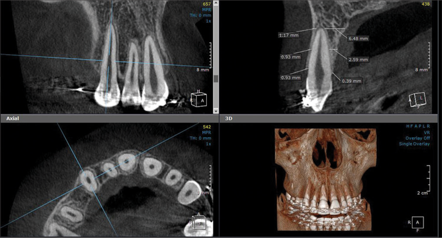 Assessment of alveolar bone thickness on both the buccal and palatal sides of the maxillary canine, at three levels along the canine root: coronal, mid-root, and apical (3D Module, OnDemand3DTM App software).
