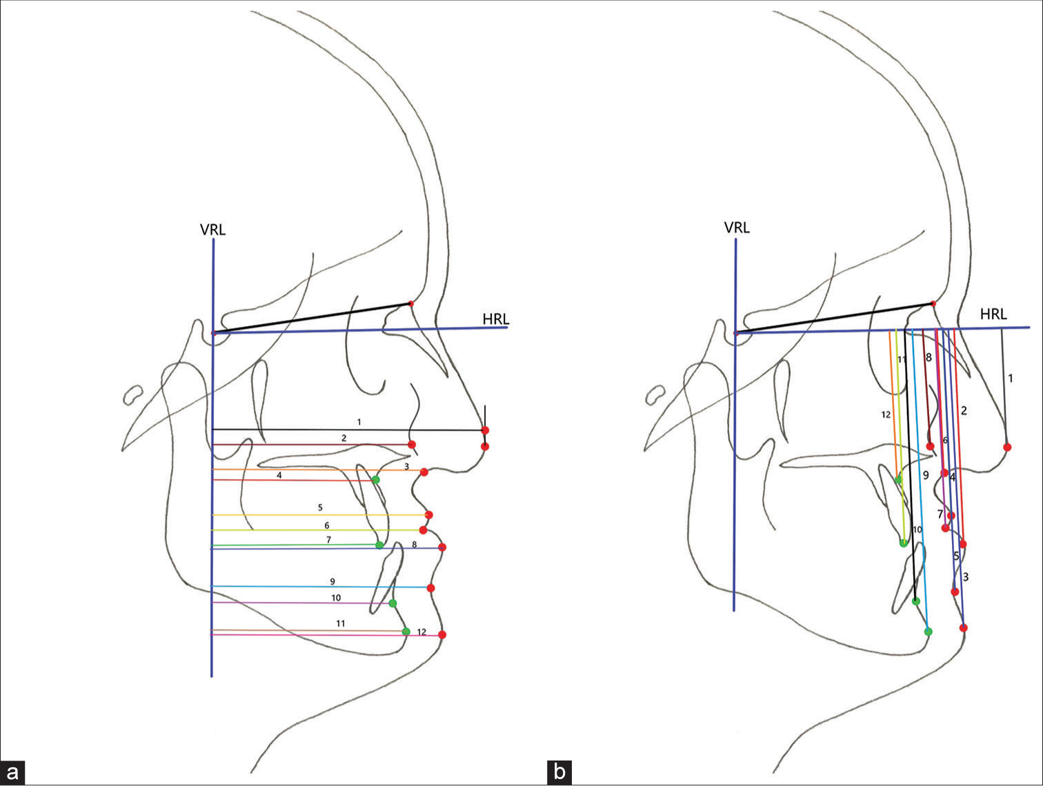 (a) Horizontal distance from vertical reference line to hard-tissue (Green dot) and soft-tissue (Red dot) landmarks: Horizontal distance from VRL to: 1: Pronasale (Point located on a tangent drawn perpendicular to HRL from Pn to avoid overlapping of 1 and 2), 2: Cheek point, 3: Subnasale, 4: Point A, 5: Labrale superius, 6: Stomion, 7: Upper incisor tip, 8: Labrale inferius, 9: Labiomentale, 10: Point B, 11: Pogonion, 12: Soft-tissue Pogonion. (b): Vertical distance from HRL to hard-tissue (Green dot) and soft-tissue (Red dot) landmarks: Vertical distance from HRL to: 1: Pronasale, 2: Labrale Inferius, 3: Soft-tissue Pogonion, 4: Labrale superius, 5: Labiomentale, 6: Subnasale, 7: Stomion, 8: Cheekpoint, 9: Pogonion, 10: Point B, 11: Upper incisor tip, 12: Point A, VRL: Vertical reference line, HRL: Horizontal reference line.