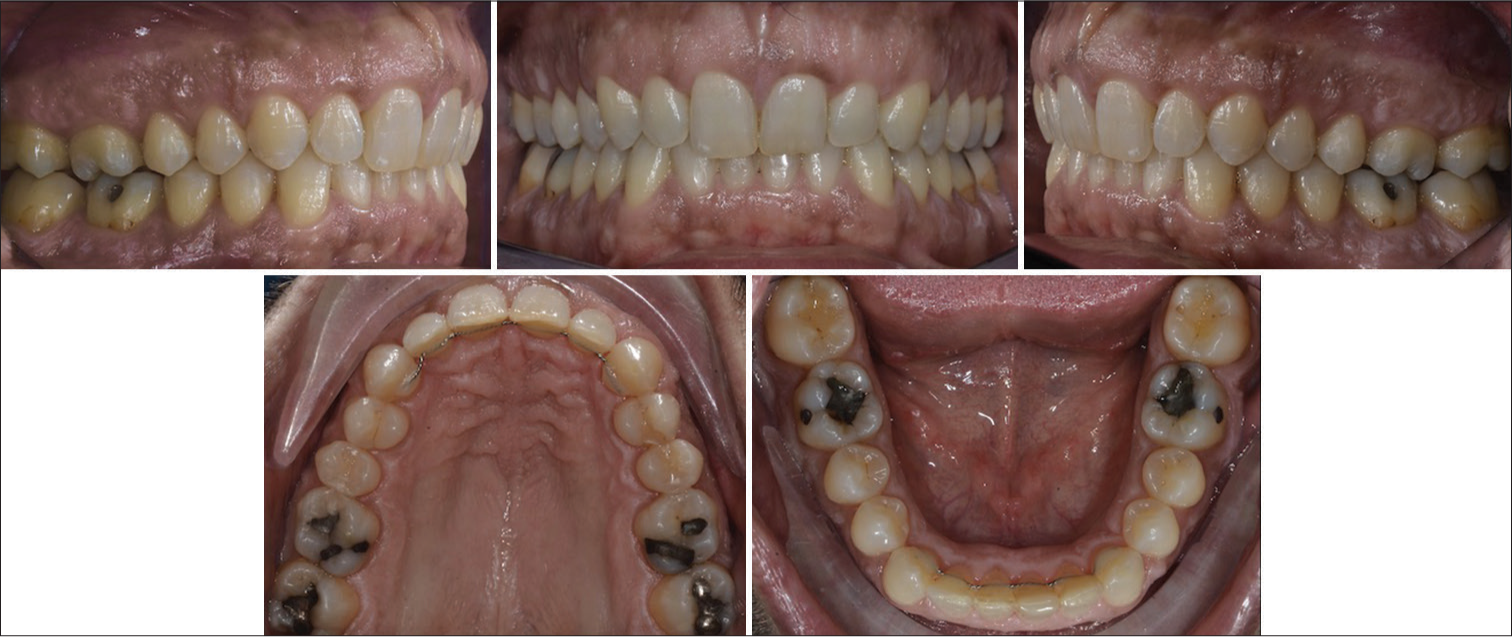 Intraoral photos at one year.