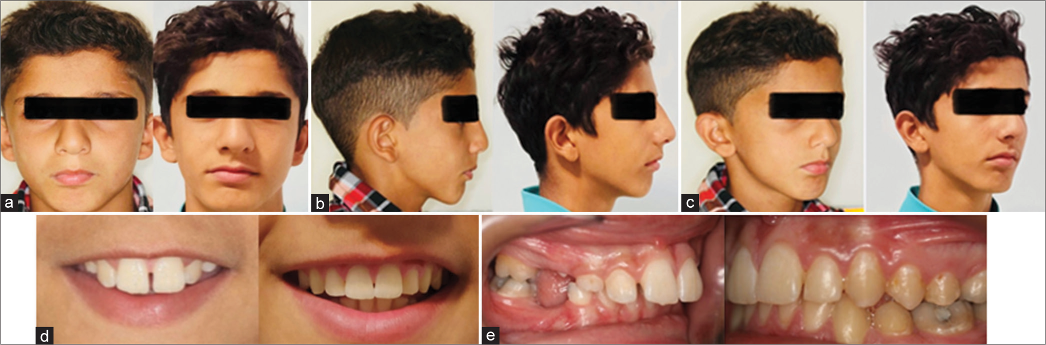 Pre- and post-treatment photographs: (a) frontal view, (b) profile view, (c) oblique view, (d) smile view, and (e) intraoral view.