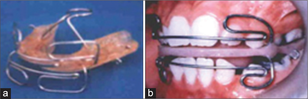 (a) Farmand II functional appliance, (b) patient treated with Farmand II functional appliance