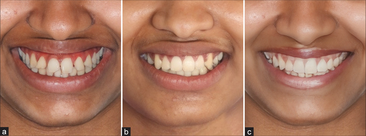 Artificial intelligence (AI) predicted image with least accuracy. (a) Pre-treatment image used for comparison. (b) Actual post-treatment image. (c) AI predicted post-treatment image.