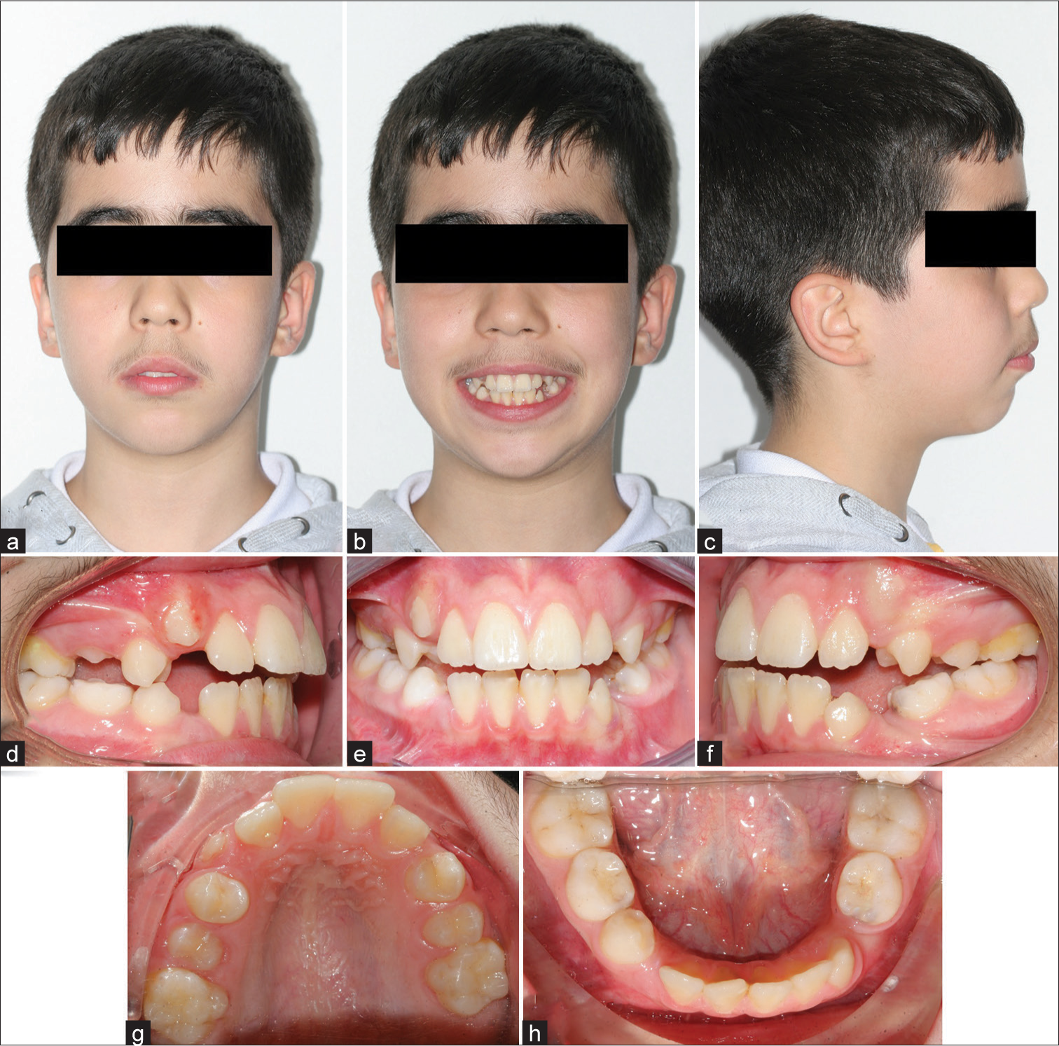 Intraoral and extraoral photographs of patient 2 pre-treatment. (a) Frontal extraoral photograph. (b) Smiling extraoral photograph. (c) Lateral extraoral photograph. (d) Right intraoral photograph. (e) Frontal intraoral photograph. (f) Left intraoral photograph. (g) Occlusal view of maxillary arch. (h) Occlusal view of mandibular arch.