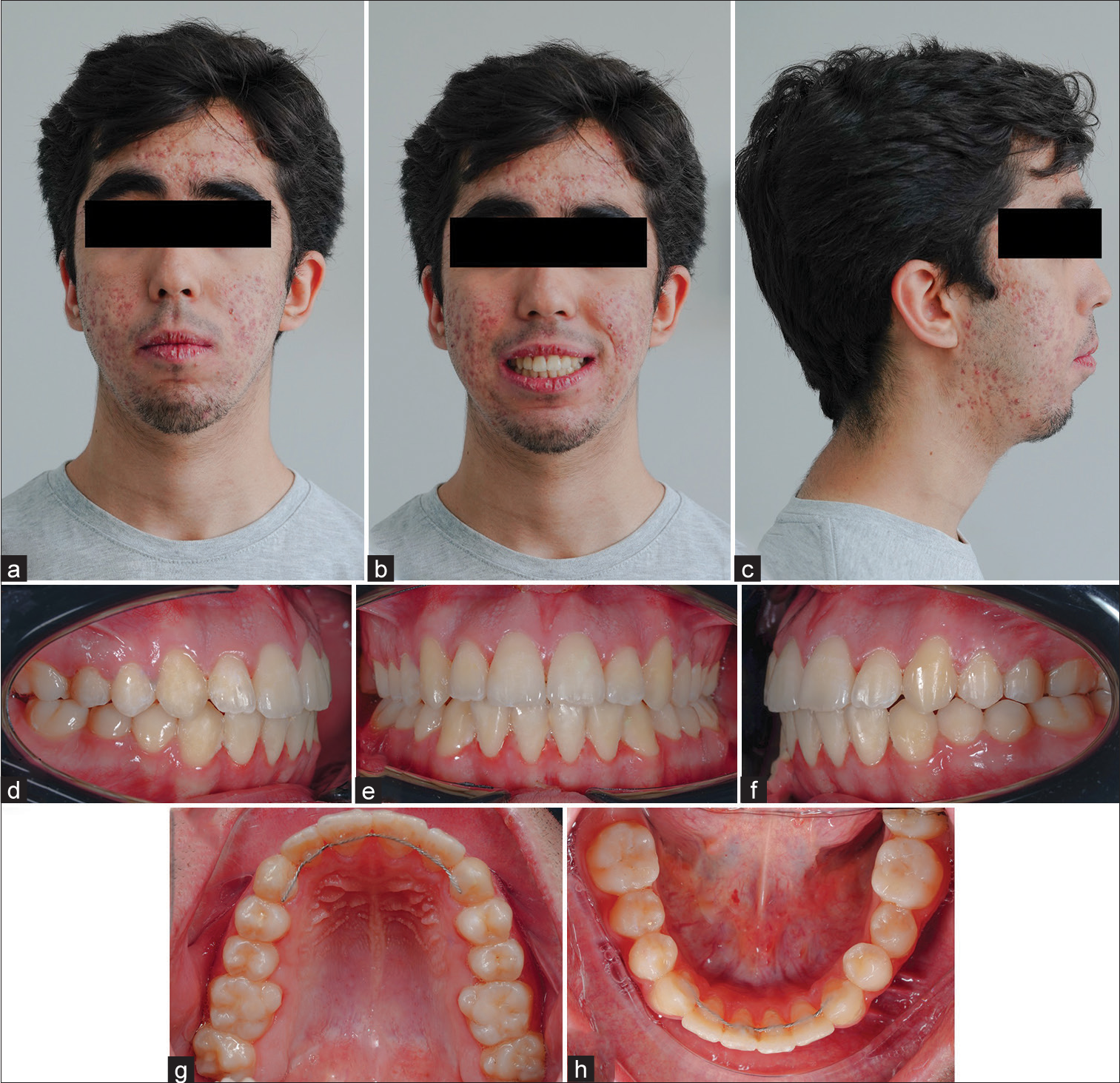 Intraoral and extraoral photographs of patient 1 post-treatment. (a) Frontal extraoral photograph. (b) Smiling extraoral photograph. (c) Lateral extraoral photograph. (d) Right intraoral photograph. (e) Frontal intraoral photograph. (f) Left intraoral photograph. (g) Occlusal view of maxillary arch. (h ) Occlusal view of mandibular arch.